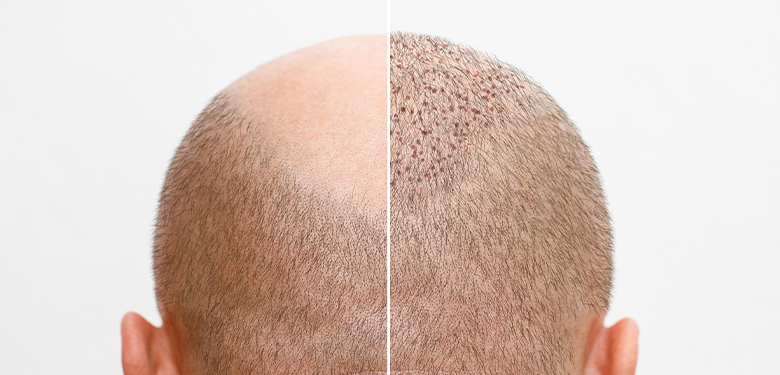 DHI Saç Ekimi DHI Saç Ekimi